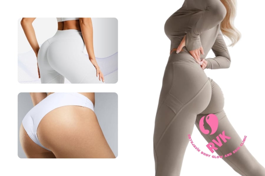 Brazilian butt lift (BBL) meðferð hjá Reykjavík Body Glow and Skin Clinic